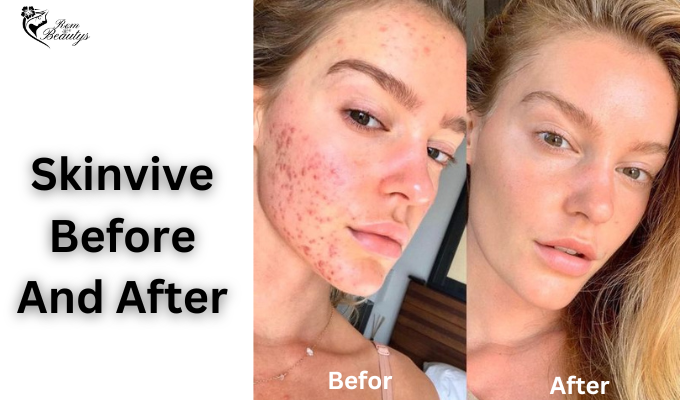 Skinvive Before And After Result & Photos - Rem Beautys