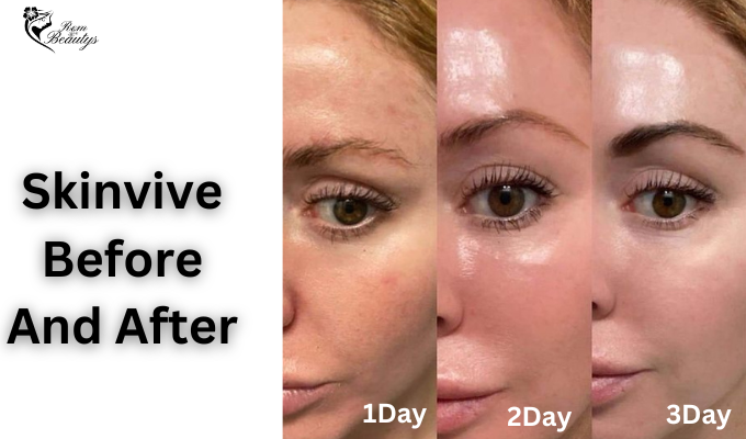 Skinvive Before And After Result & Photos - Rem Beautys